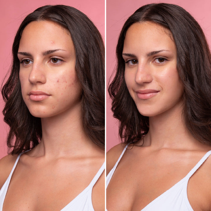 ByePimples - Tratamiento Natural Anti Acné | Eco Bio Boutique