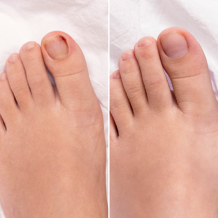 Nail Cure - Tratamiento para uñas encarnadas | Eco Bio Boutique