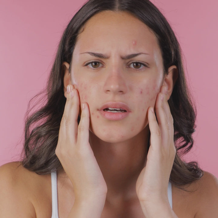 ByePimples - Tratamiento Natural Anti Acné | Eco Bio Boutique