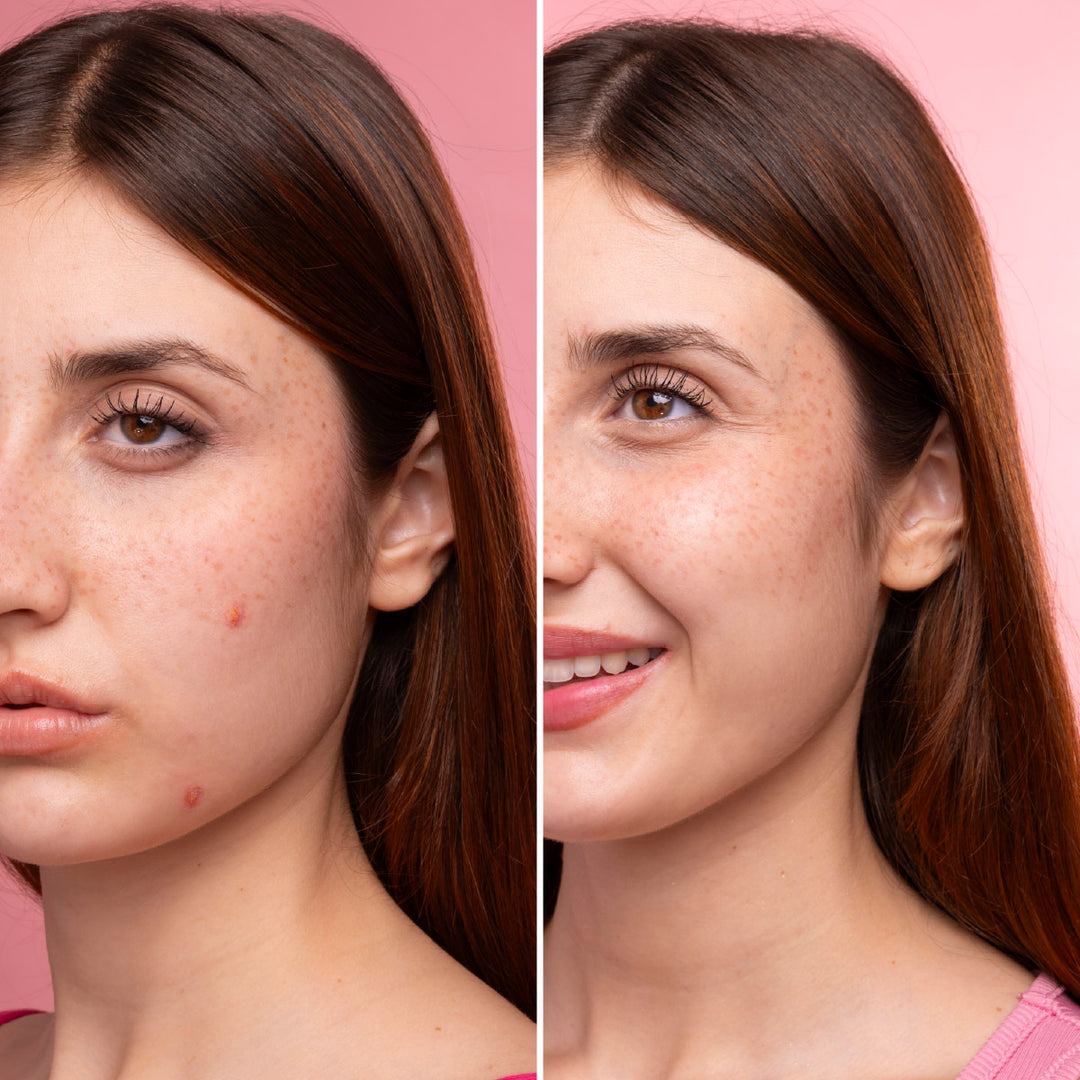 ByePimples Plus - Tratamiento de choque antiacné | Eco Bio Boutique