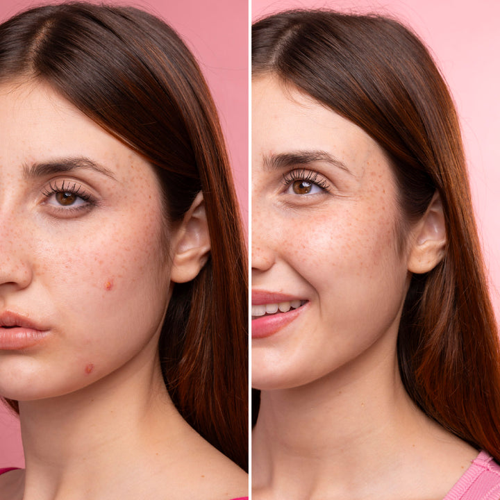 ByePimples Plus - Tratamiento de choque antiacné | Eco Bio Boutique